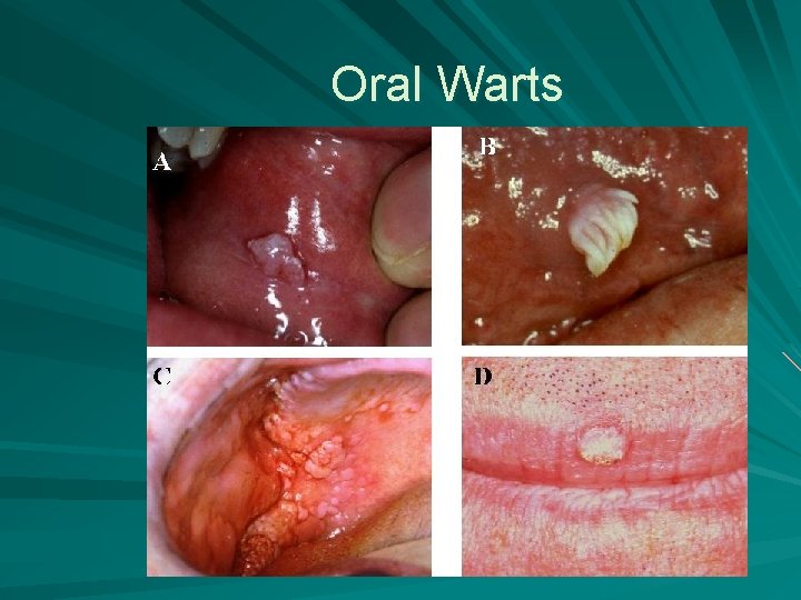 Oral Warts 