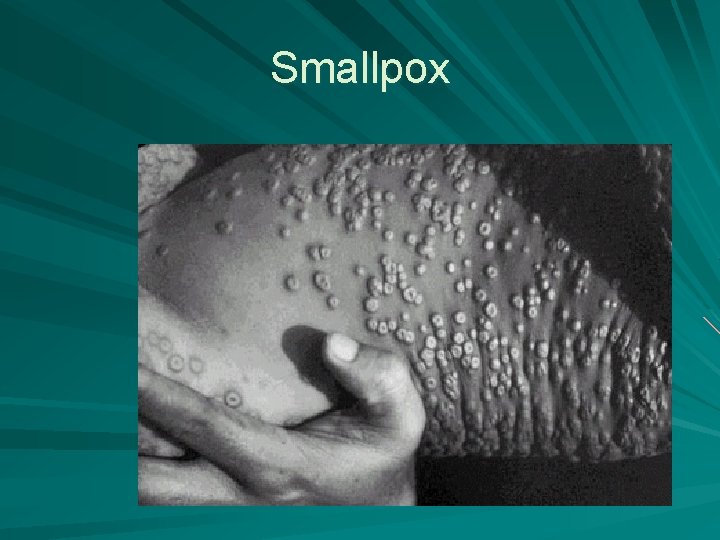Smallpox 