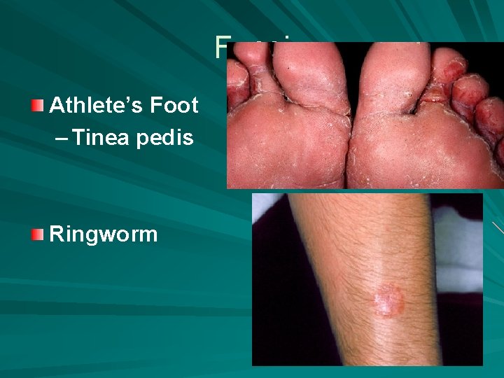 Fungi Athlete’s Foot – Tinea pedis Ringworm 