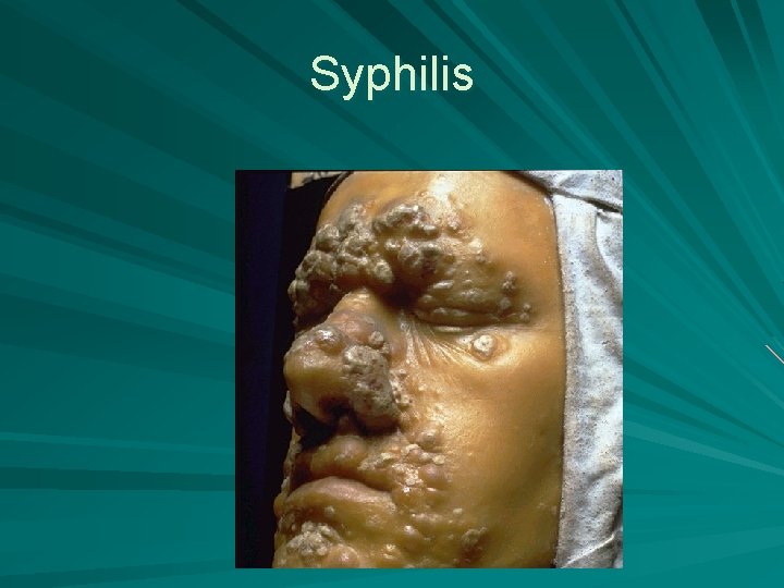 Syphilis 