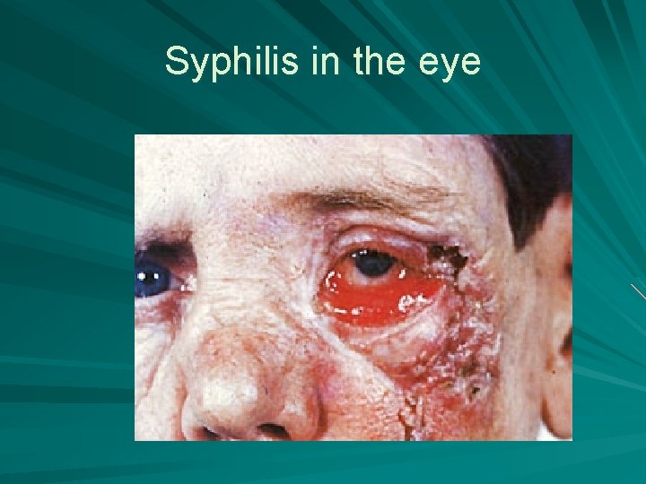 Syphilis in the eye 