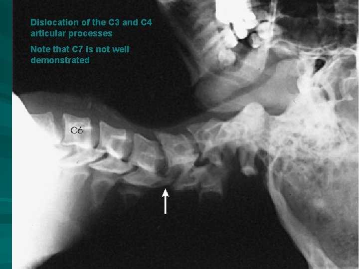 Dislocation of the C 3 and C 4 articular processes Note that C 7