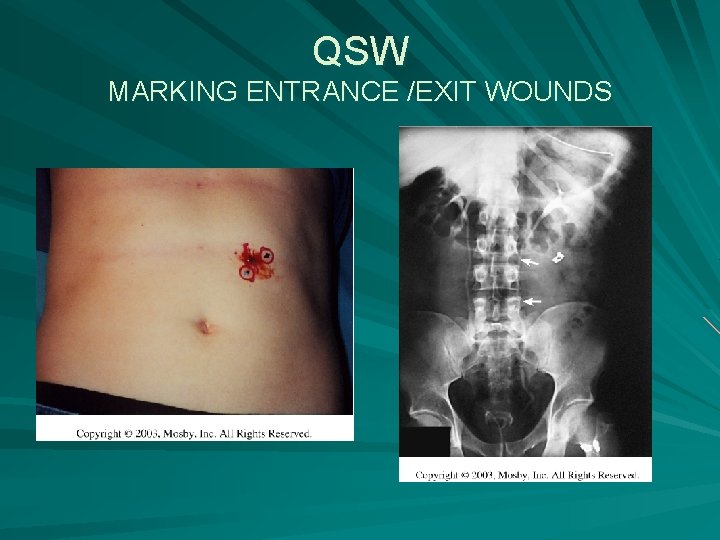 QSW MARKING ENTRANCE /EXIT WOUNDS 