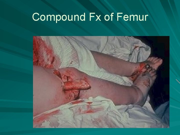 Compound Fx of Femur 