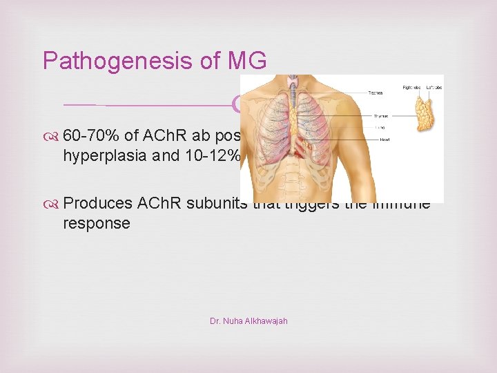 Pathogenesis of MG 60 -70% of ACh. R ab positive patients have thymic hyperplasia