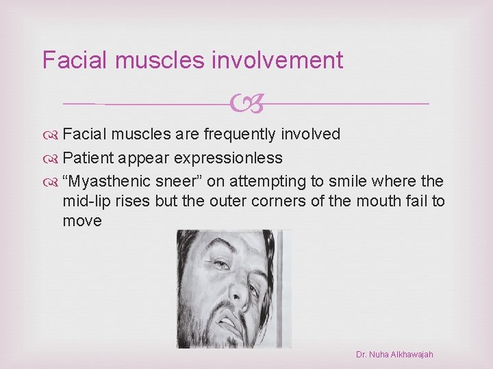 Facial muscles involvement Facial muscles are frequently involved Patient appear expressionless “Myasthenic sneer” on