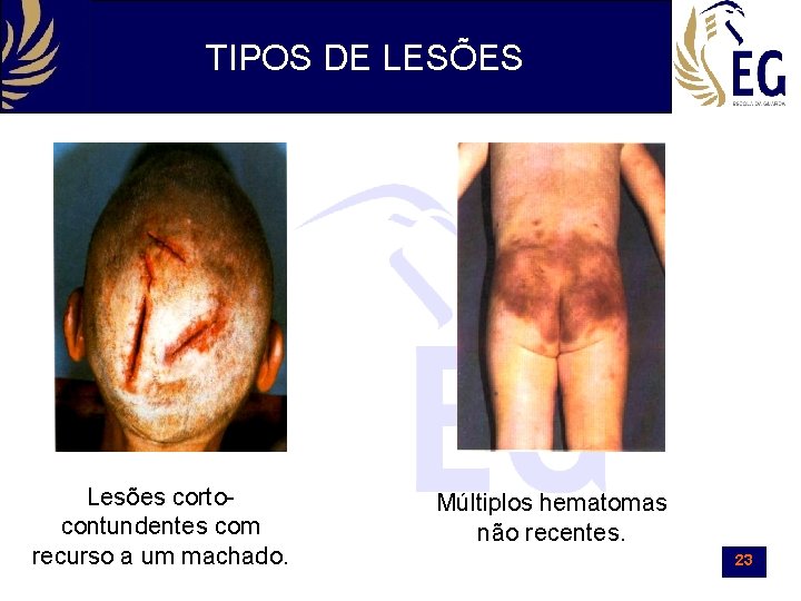 TIPOS DE LESÕES Lesões cortocontundentes com recurso a um machado. Múltiplos hematomas não recentes.