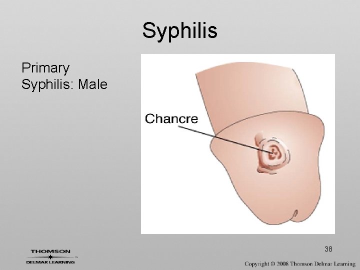 Syphilis Primary Syphilis: Male 38 