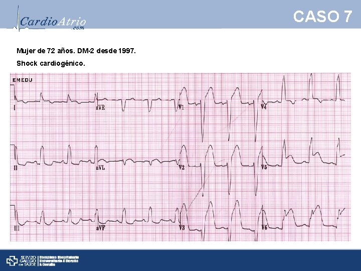 CASO 7 Mujer de 72 años. DM-2 desde 1997. Shock cardiogénico. 
