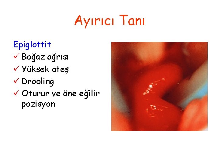 Ayırıcı Tanı Epiglottit ü Boğaz ağrısı ü Yüksek ateş ü Drooling ü Oturur ve