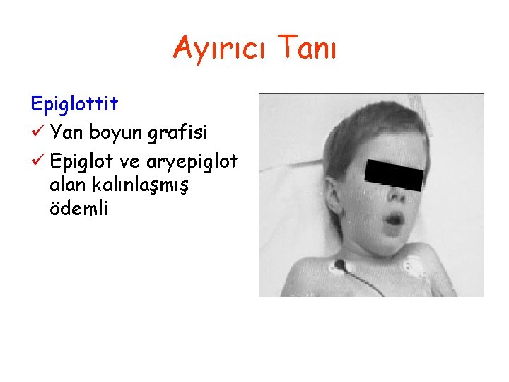 Ayırıcı Tanı Epiglottit ü Yan boyun grafisi ü Epiglot ve aryepiglot alan kalınlaşmış ödemli