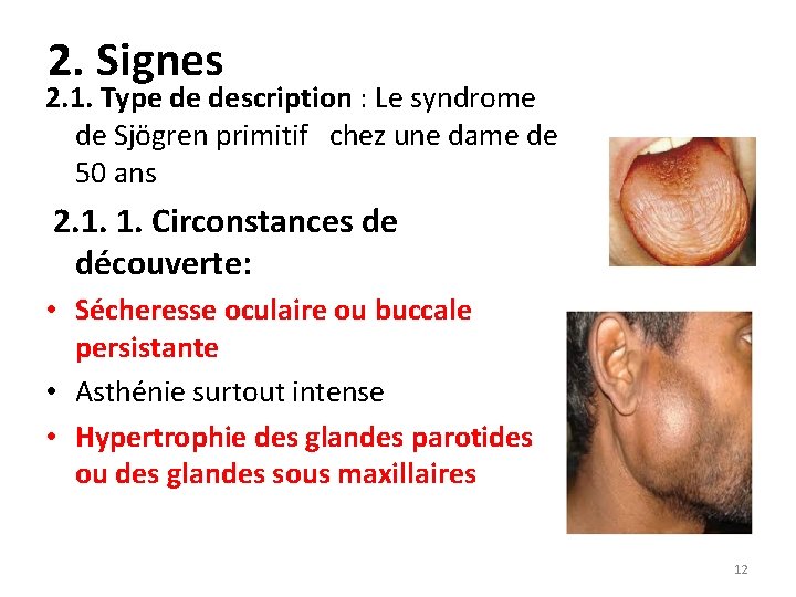2. Signes 2. 1. Type de description : Le syndrome de Sjögren primitif chez