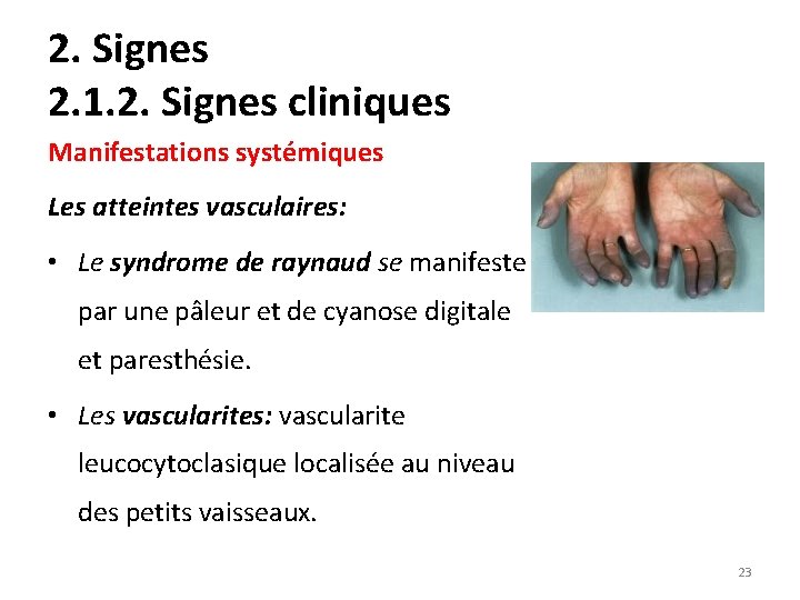 2. Signes 2. 1. 2. Signes cliniques Manifestations systémiques Les atteintes vasculaires: • Le