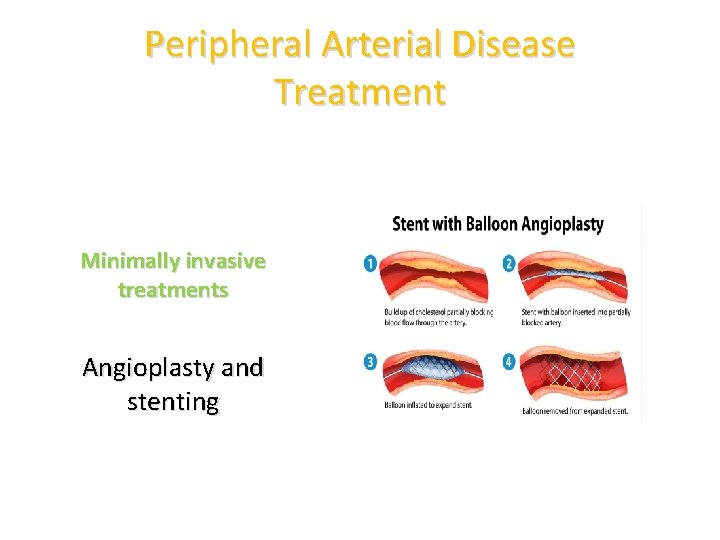 Peripheral Arterial Disease Treatment Minimally invasive treatments Angioplasty and stenting 