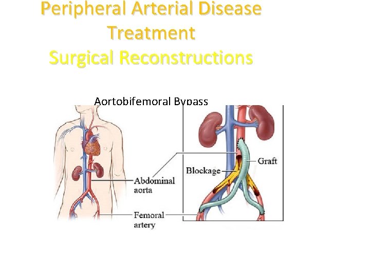Peripheral Arterial Disease Treatment Surgical Reconstructions Aortobifemoral Bypass 