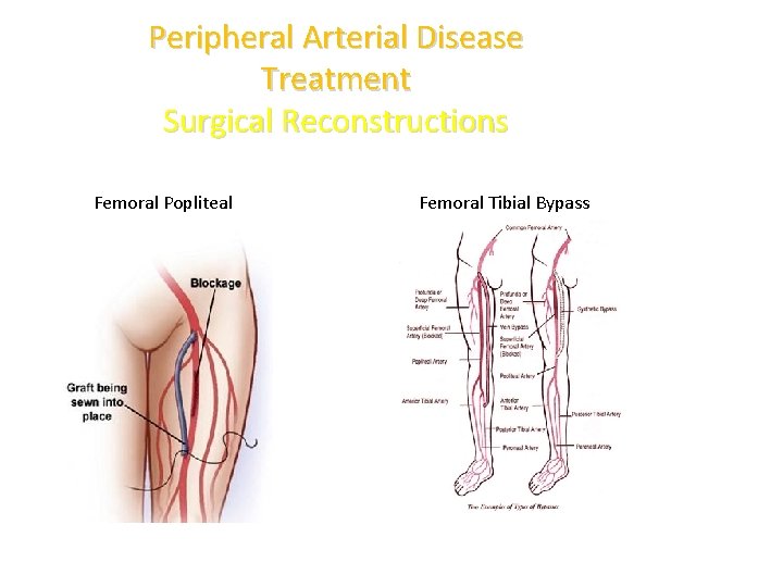 Peripheral Arterial Disease Treatment Surgical Reconstructions Femoral Popliteal Femoral Tibial Bypass 