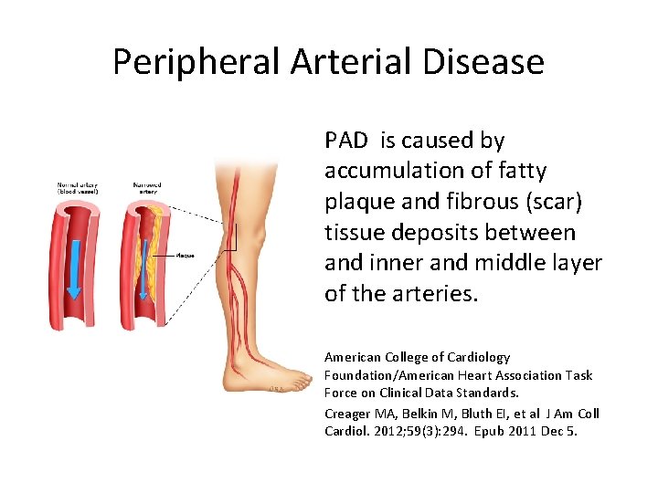 Peripheral Arterial Disease PAD is caused by accumulation of fatty plaque and fibrous (scar)