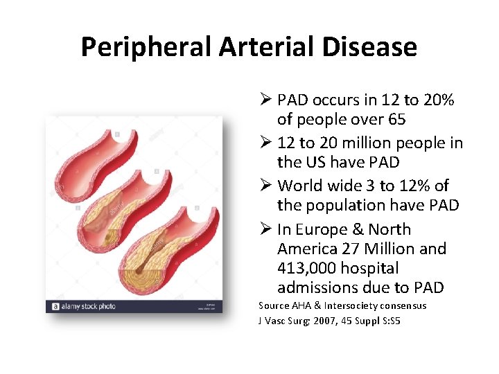 Peripheral Arterial Disease Ø PAD occurs in 12 to 20% of people over 65