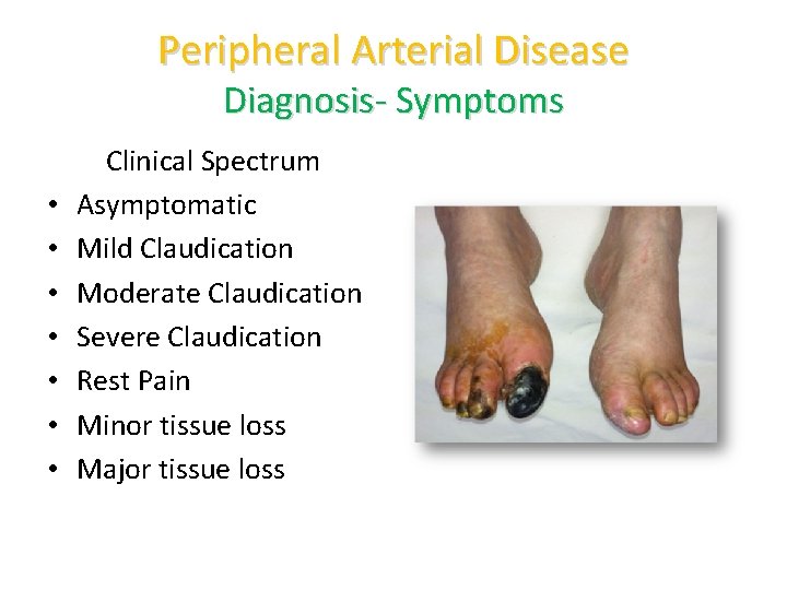 Peripheral Arterial Disease Diagnosis- Symptoms • • Clinical Spectrum Asymptomatic Mild Claudication Moderate Claudication
