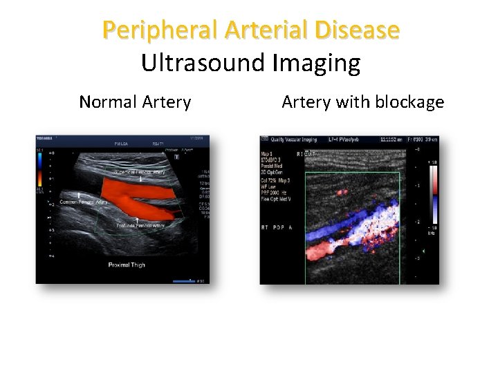 Peripheral Arterial Disease Ultrasound Imaging Normal Artery with blockage 