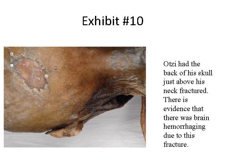 Exhibit #10 Otzi had the back of his skull just above his neck fractured.