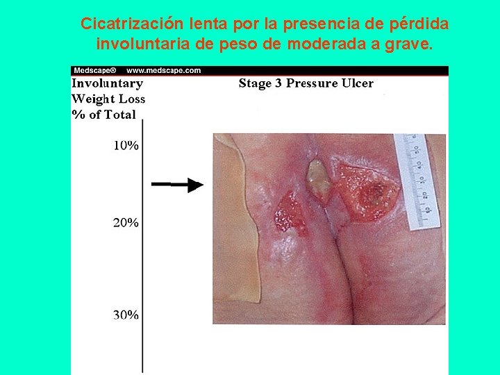 Cicatrización lenta por la presencia de pérdida involuntaria de peso de moderada a grave.