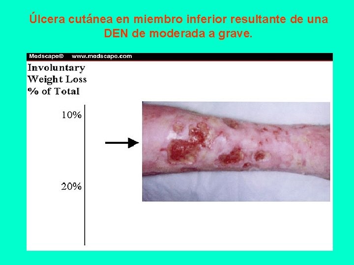 Úlcera cutánea en miembro inferior resultante de una DEN de moderada a grave. 