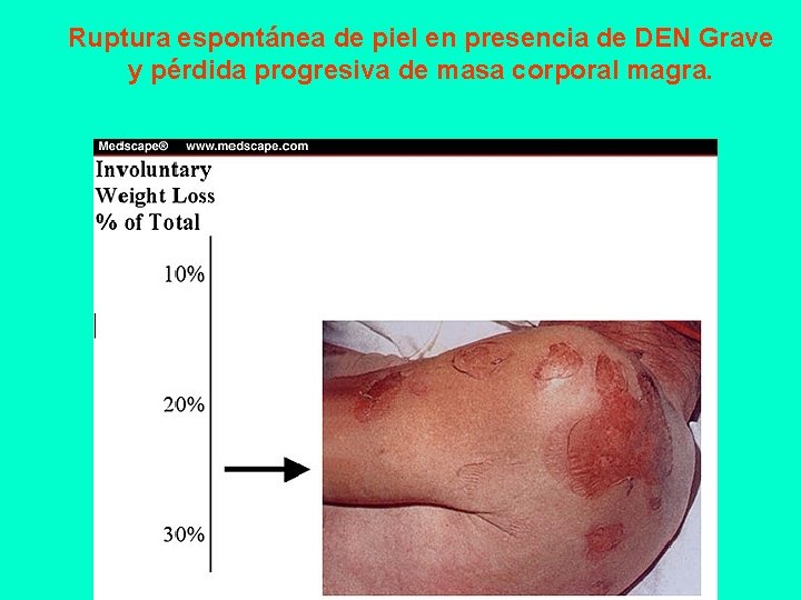 Ruptura espontánea de piel en presencia de DEN Grave y pérdida progresiva de masa