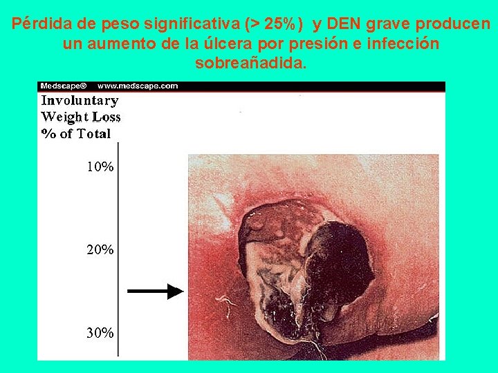 Pérdida de peso significativa (> 25%) y DEN grave producen un aumento de la