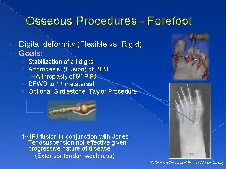 Osseous Procedures - Forefoot Digital deformity (Flexible vs. Rigid) Goals: › Stabilization of all