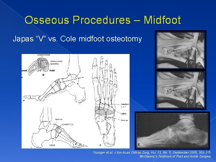 Osseous Procedures – Midfoot Japas “V” vs. Cole midfoot osteotomy Younger et al. J
