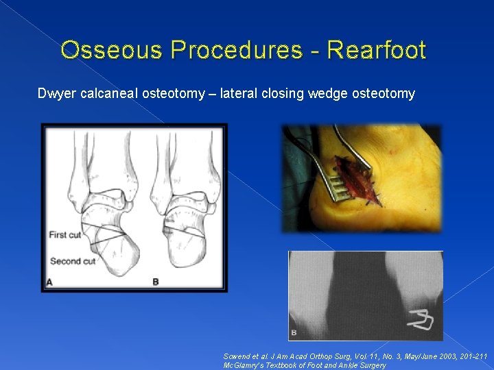 Osseous Procedures - Rearfoot Dwyer calcaneal osteotomy – lateral closing wedge osteotomy Scwend et