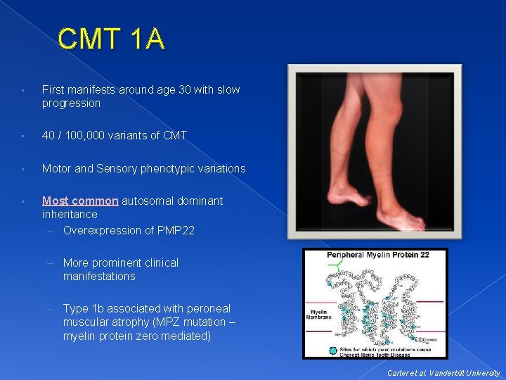 CMT 1 A • First manifests around age 30 with slow progression • 40