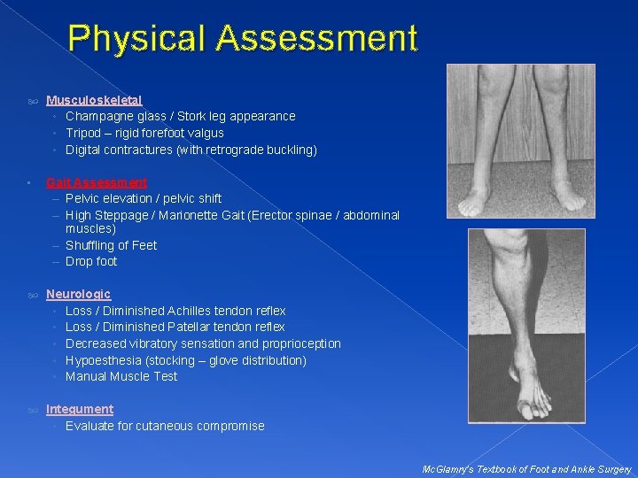 Physical Assessment Musculoskeletal ◦ Champagne glass / Stork leg appearance ◦ Tripod – rigid