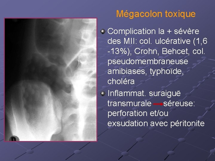 Mégacolon toxique Complication la + sévère des MII: col. ulcérative (1, 6 -13%), Crohn,