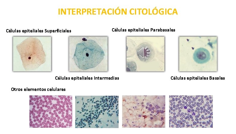 INTERPRETACIÓN CITOLÓGICA Células epiteliales Superficiales Células epiteliales Parabasales Células epiteliales Intermedias Otros elementos celulares