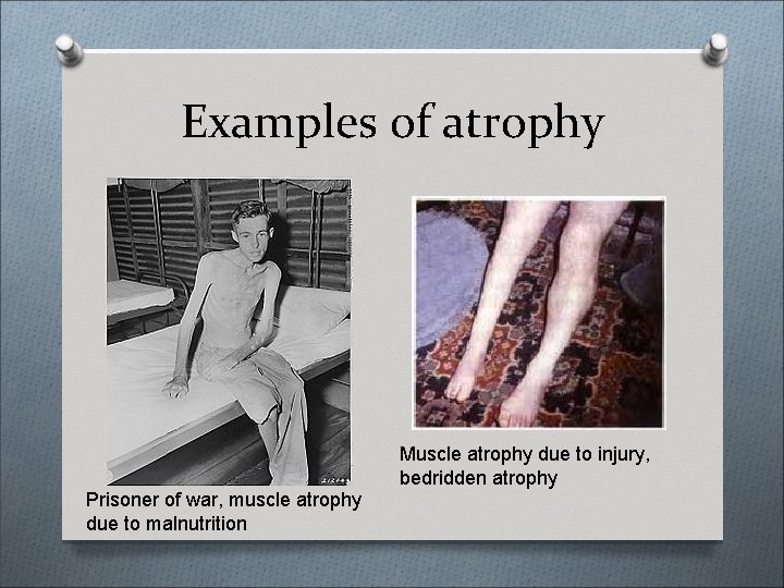 Examples of atrophy Muscle atrophy due to injury, bedridden atrophy Prisoner of war, muscle