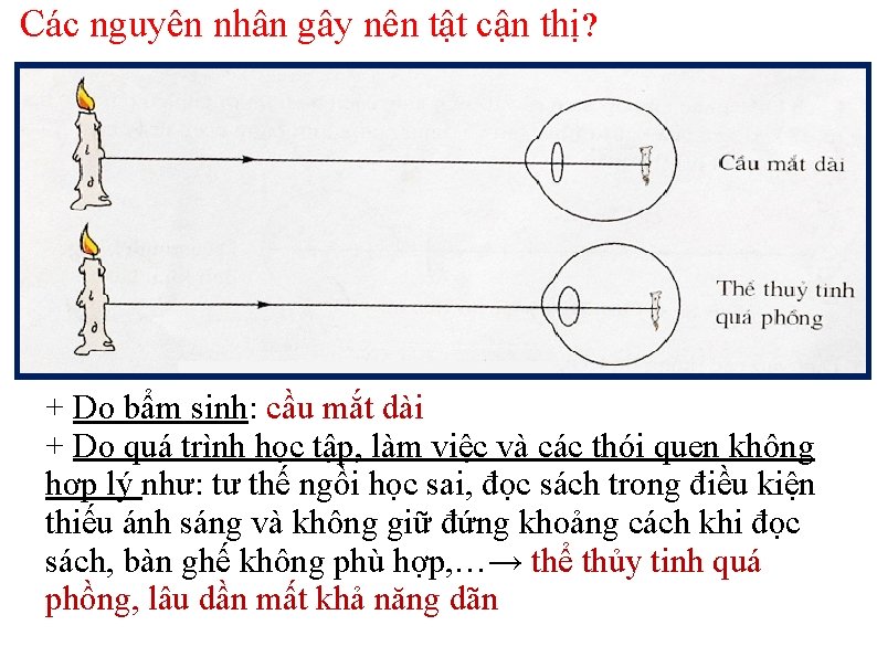 Các nguyên nhân gây nên tật cận thị? + Do bẩm sinh: cầu mắt