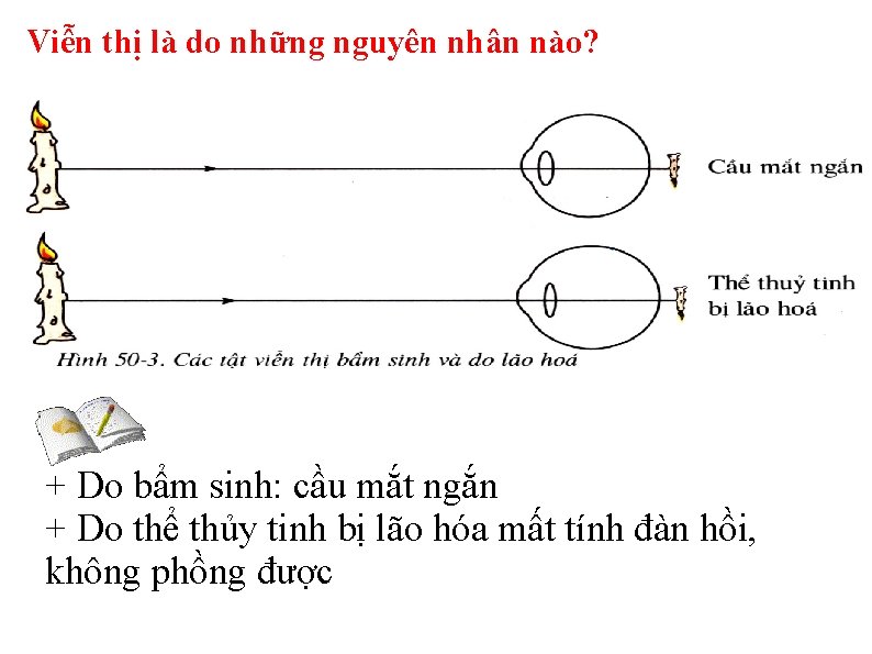 Viễn thị là do những nguyên nhân nào? + Do bẩm sinh: cầu mắt