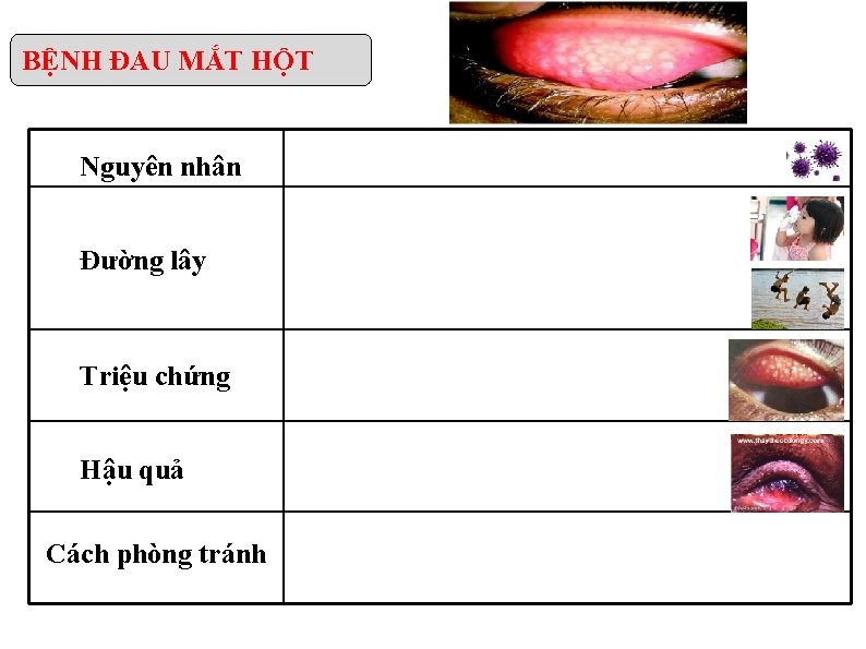 BỆNH ĐAU MẮT HỘT Nguyên nhân Đường lây Triệu chứng Hậu quả Cách phòng