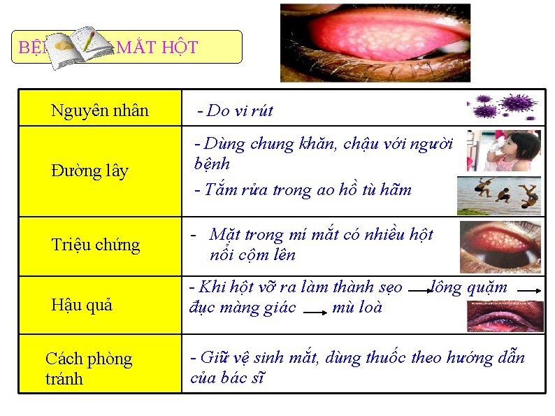BỆNH ĐAU MẮT HỘT Nguyên nhân - Do vi rút Đường lây - Dùng