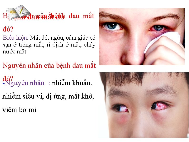 Biểu hiện Bệnh đaucủa mắtbệnh đỏ đau mắt đỏ? Biểu hiện: Mắt đỏ, ngứa,