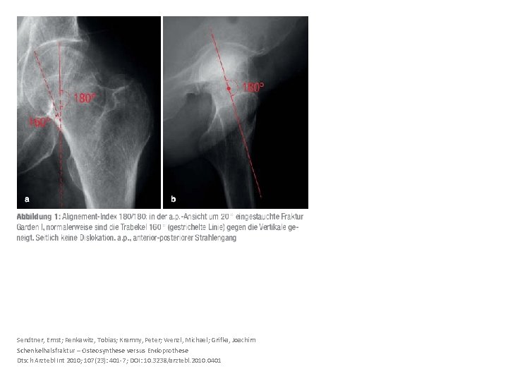 Sendtner, Ernst; Renkawitz, Tobias; Kramny, Peter; Wenzl, Michael; Grifka, Joachim Schenkelhalsfraktur – Osteosynthese versus