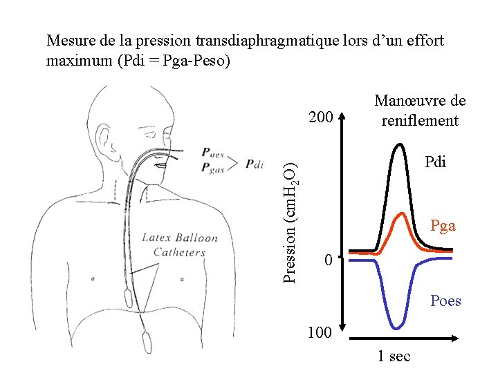 Mesure de la pression transdiaphragmatique lors d’un effort maximum (Pdi = Pga-Peso) Pression (cm.