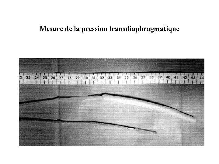 Mesure de la pression transdiaphragmatique 