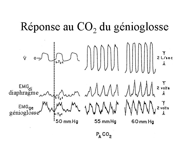 Réponse au CO 2 du génioglosse diaphragme génioglosse 