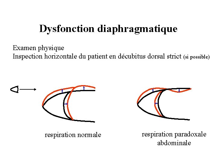 Dysfonction diaphragmatique Examen physique Inspection horizontale du patient en décubitus dorsal strict (si possible)