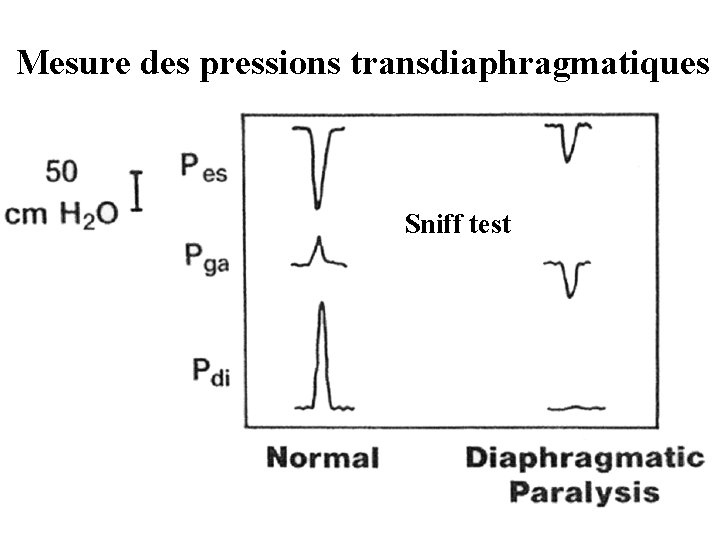 Mesure des pressions transdiaphragmatiques Sniff test 