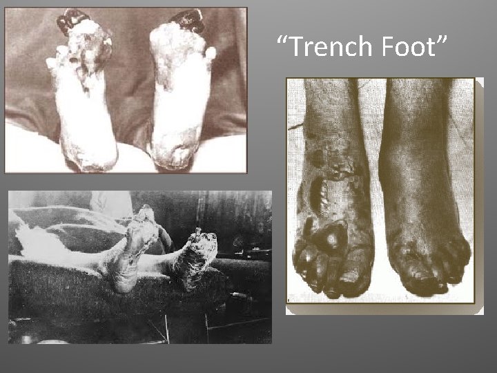 “Trench Foot” 