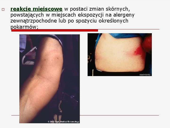 o reakcje miejscowe w postaci zmian skórnych, powstających w miejscach ekspozycji na alergeny zewnątrzpochodne